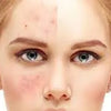 How-to-Control-Acne AFTech Skincare